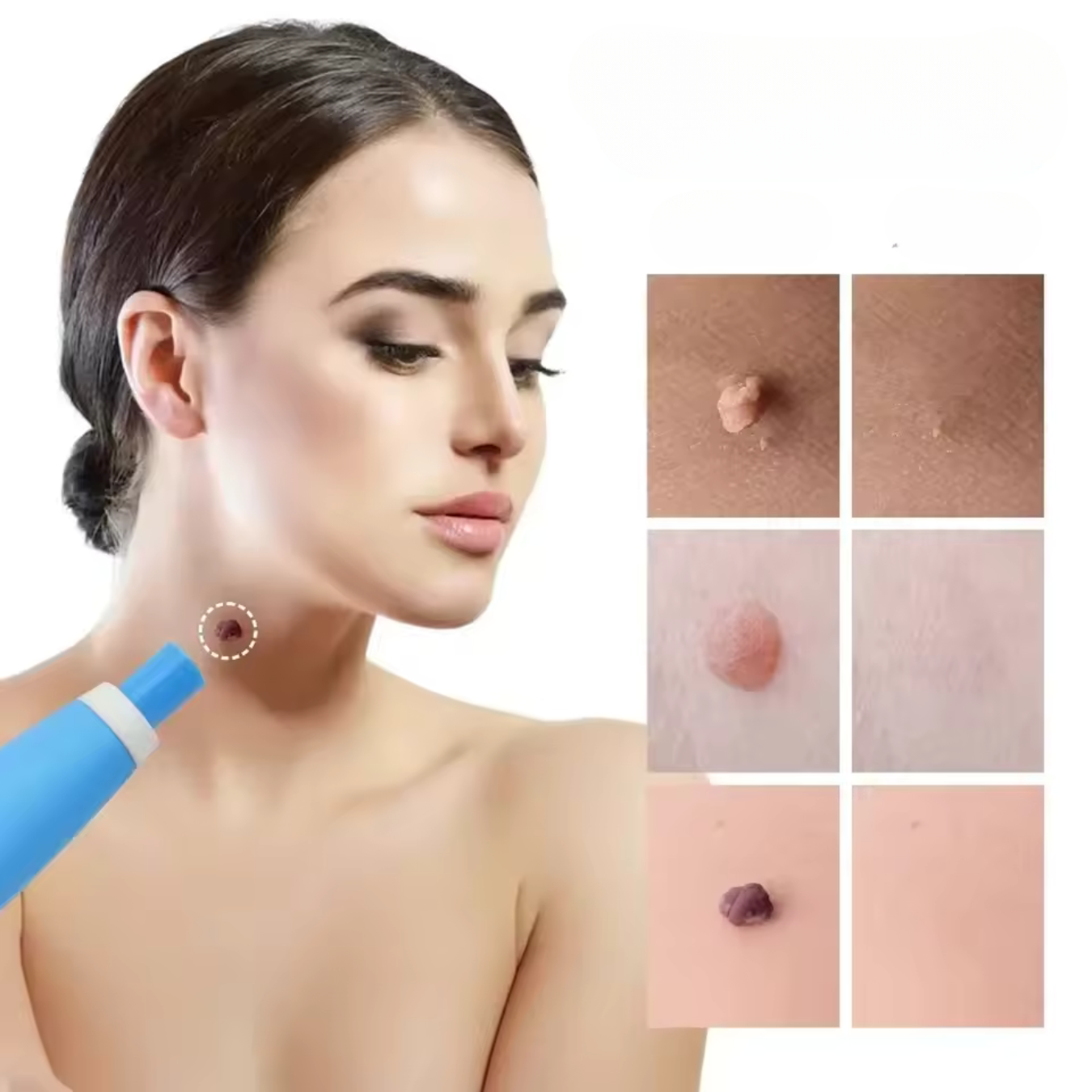 VerrueStop Éliminateur d’acrochordons